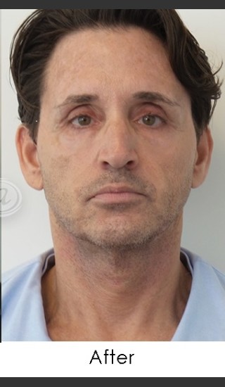 After Photo for Sculptra Rejuvenation for Man - Annie Chiu, MD - Prejuvenation