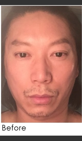 Before Photo for Sculptra for Male Facial Rejuvenation - Annie Chiu, MD - Prejuvenation