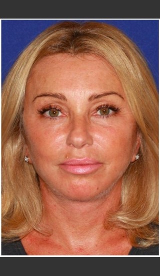 After Photo for Facelift - Case 27 - Konstantin Vasyukevich, MD - Prejuvenation