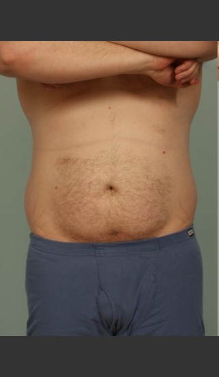 Before Photo for Liposuction - El Paso Cosmetic Surgery - Prejuvenation