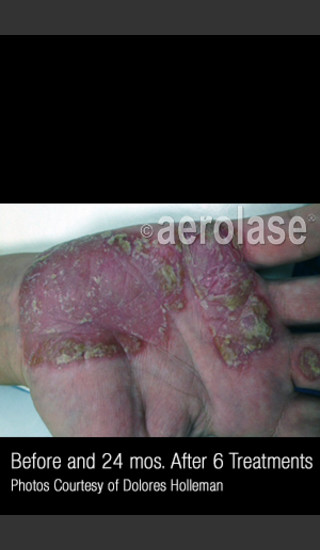 Before Photo for Treatment of Psoriasis #335 -  - Prejuvenation