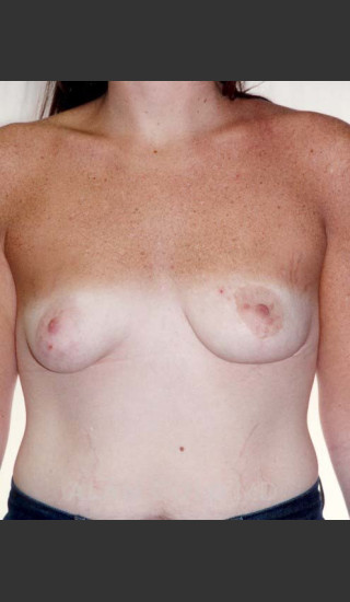 After Photo for Asymmetrical Breast 481 - Alan Gold MD - Prejuvenation