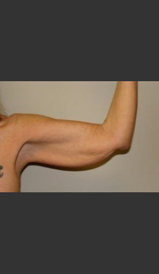 Before Photo for Arm Lift 7961 - Sanjay Grover MD FACS - Prejuvenation