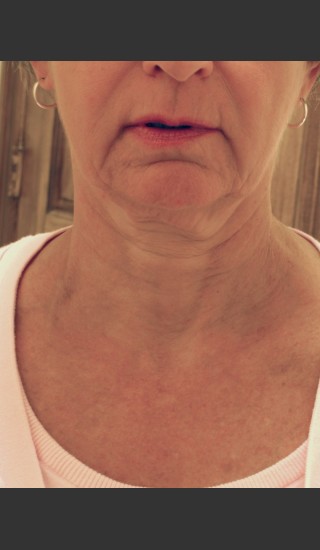 After Photo for 3DEEP Neck Tightening -  - Prejuvenation
