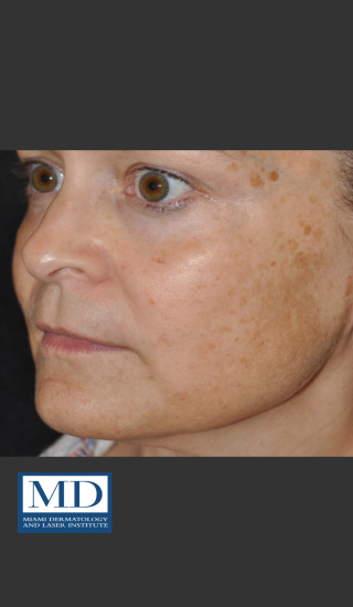 Before Photo for Melasma Face Treatment 116 - Jill S. Waibel, MD - Prejuvenation