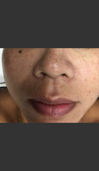 Before Photo for IPL Photofacial  - Janell Ocampo - Prejuvenation