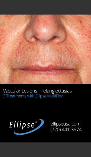 Before Photo for 3 Full Face Rejuvenation Treatments -  - Prejuvenation