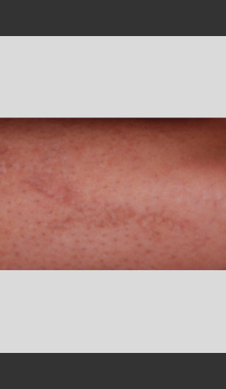 After Photo for PicoWay Tattoo Removal of Barb Wire -  - Prejuvenation