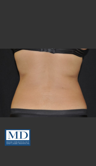 After Photo for  Body Contouring Treatment 141 - Jill S. Waibel, MD - Prejuvenation