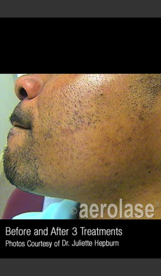 After Photo for Hair Removal #314 -  - Prejuvenation