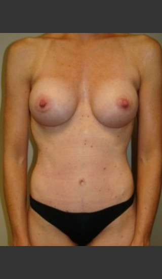 After Photo for Mommy Makeover 8468 - Sanjay Grover MD FACS - Prejuvenation