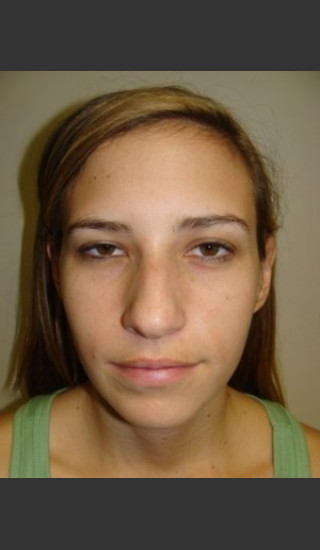 Before Photo for Chin Augmentation with Rhinoplasty 6579 - Sanjay Grover MD FACS - Prejuvenation