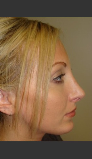 After Photo for Rhinoplasty 6574 - Sanjay Grover MD FACS - Prejuvenation