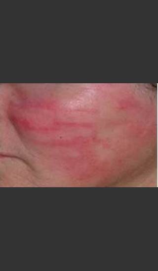 After Photo for IPL Treatment #18 - Harvey H. Jay, M.D. - Prejuvenation