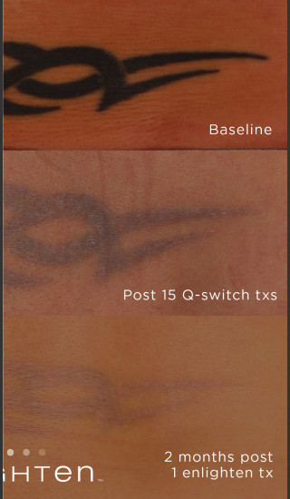 After Photo for Tattoo Removal on Lower Back -  - Prejuvenation