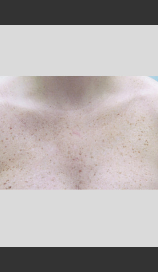 Before Photo for Gentle Laser Skin Rejuvenation Treatment -  - Prejuvenation