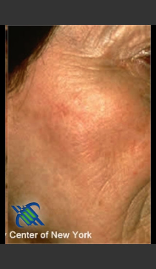 After Photo for Treatment of Brown Spot on Cheek - Roy G. Geronemus, M.D. - Prejuvenation