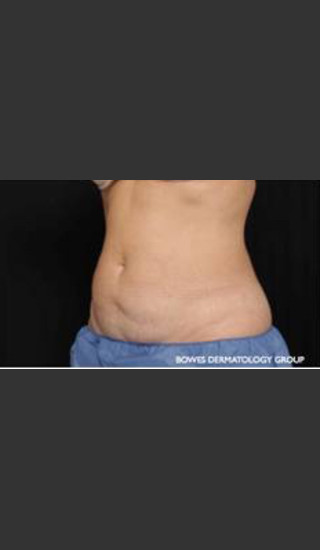 After Photo for CoolSculpting Treatment of Woman's Abdomen - Leyda Elizabeth Bowes, M.D. - Prejuvenation