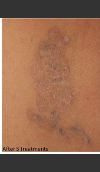 After Photo for Treatment of Tattoo -  - Prejuvenation