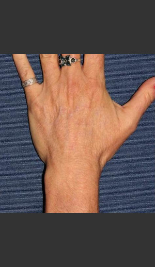 After Photo for Sun Spot Removal on Hands - Dr. Sabrina G. Fabi - Prejuvenation