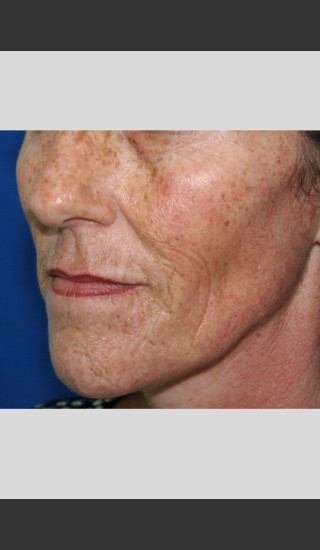 Before Photo for elos for Color Correction -  - Prejuvenation