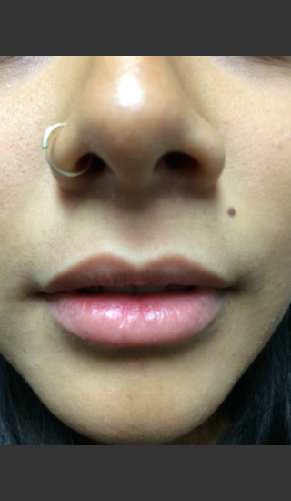 Before Photo for Juvederm Injection  - Janell Ocampo - Prejuvenation