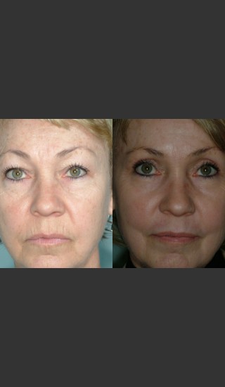After Photo for Laser resurfacing and laser eyelid surgery performed on same day. - Mark B. Taylor, M.D. - Prejuvenation