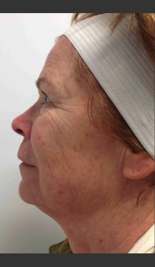 Before Photo for Infini Rhytides Treatment #17 -  - Prejuvenation