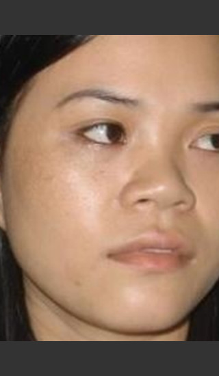 After Photo for Quanta MDK Treatment of Pigment #78 -  - Prejuvenation