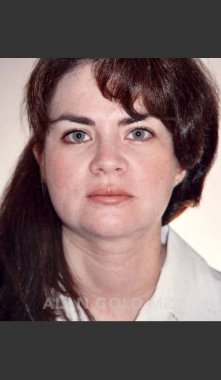 After Photo for Liposuction of Neck 96 - Alan Gold MD - Prejuvenation