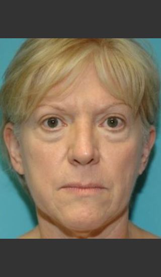 Before Photo for Blepharoplasty - Timothy Miller - Prejuvenation