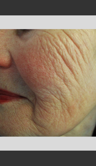 Before Photo for Profound Smooth Treatment: Volumize Cheeks -  - Prejuvenation