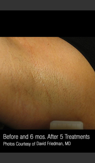 After Photo for Hair Removal #313 -  - Prejuvenation