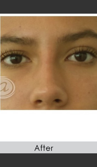 After Photo for Undereye Filler - Annie Chiu, MD - Prejuvenation