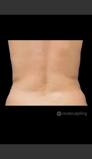 After Photo for CoolSculpting on Woman's Flanks #1 -  - Prejuvenation