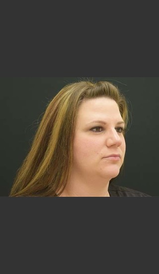 Before Photo for Kybella Double Chin Treatment - Skin Cancer Specialists P.C. & Aesthetic Center - Prejuvenation