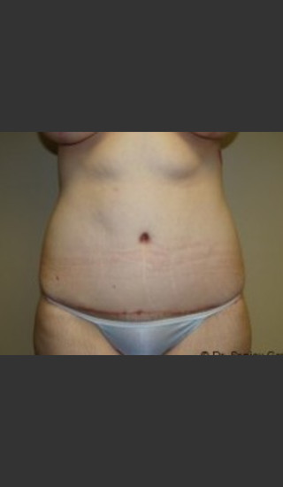 After Photo for Tummy Tuck 7163 - Sanjay Grover MD FACS - Prejuvenation