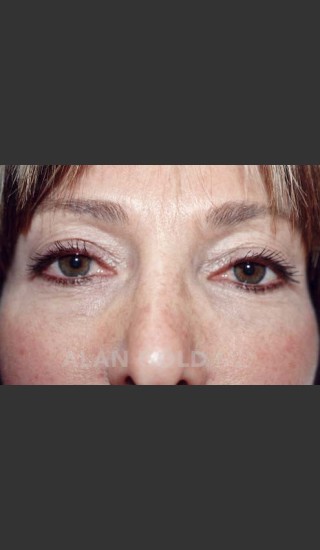 Before Photo for Blepharoplasty 1004 - Alan Gold MD - Prejuvenation