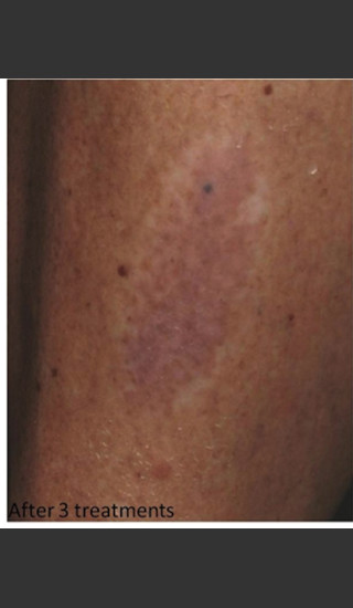 After Photo for Treatment of Tattoo -  - Prejuvenation