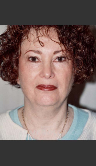 Before Photo for Liposuction of Neck 89 - Alan Gold MD - Prejuvenation