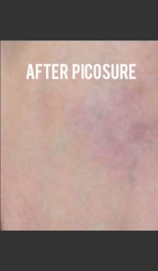 After Photo for Treatment of Tattoo with Picosure - Roy G. Geronemus, M.D. - Prejuvenation