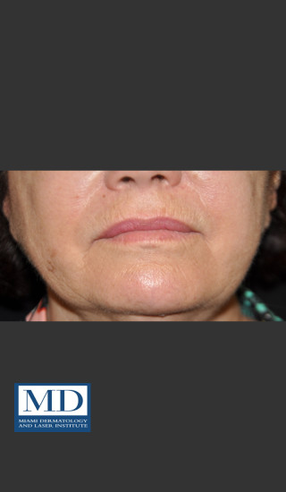 Before Photo for Wrinkle Treatment 125 - Jill S. Waibel, MD - Prejuvenation