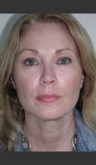 After Photo for Sculptra for Facial Volume Restoration - James Newman - Prejuvenation