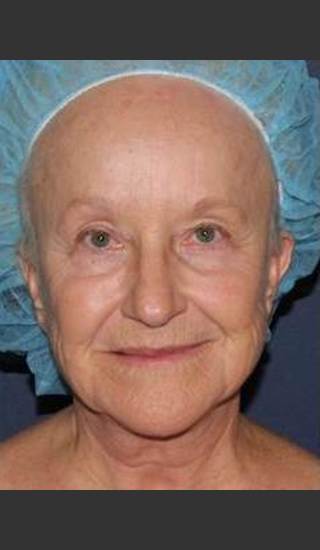 Before Photo for Reduction of Lip Lines - William F. Groff, M.D. - Prejuvenation