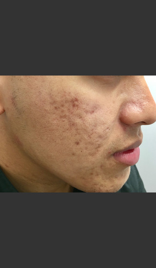 Before Photo for Microneedling  - Janell Ocampo - Prejuvenation