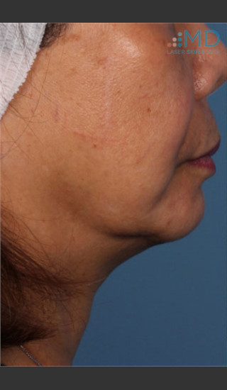 Before Photo for Ultherapy Skin Laxity Treatment of Lower Face - Margaret Ann Weiss - Prejuvenation