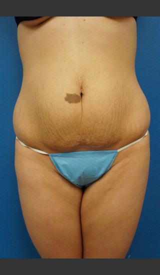 Before Photo for Abdominoplasty (Tummy Tuck) Before & After - Dr. Josh Olson - Prejuvenation