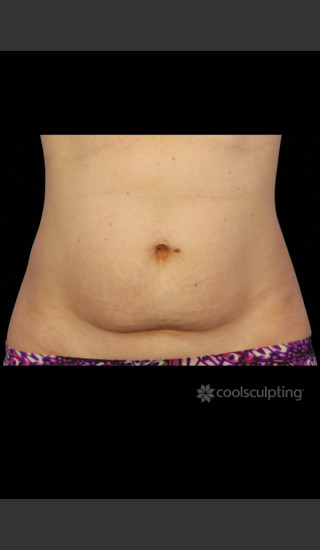 Before Photo for CoolSculpting Woman's Abdomen and Flanks - W. Grant Stevens, MD, FACS - Prejuvenation