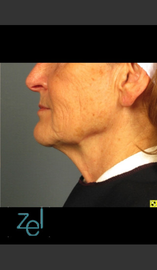 After Photo for Ultherapy on Mid Face with Dermal Fillers - Brian D. Zelickson, M.D. - Prejuvenation