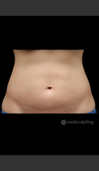 Before Photo for CoolSculpting on Woman's Stomach -  - Prejuvenation